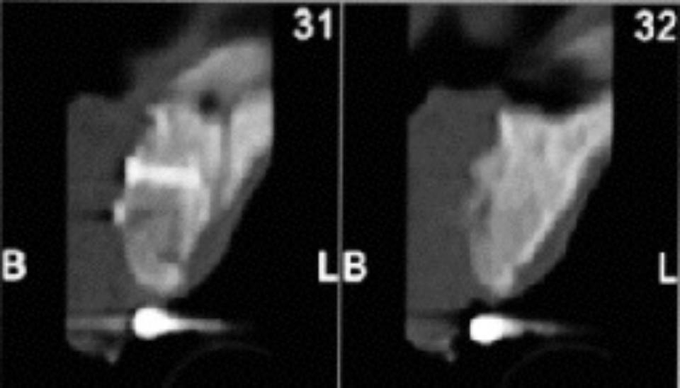 Fig. 4f: CBCT crosscut, 5 months after grafting