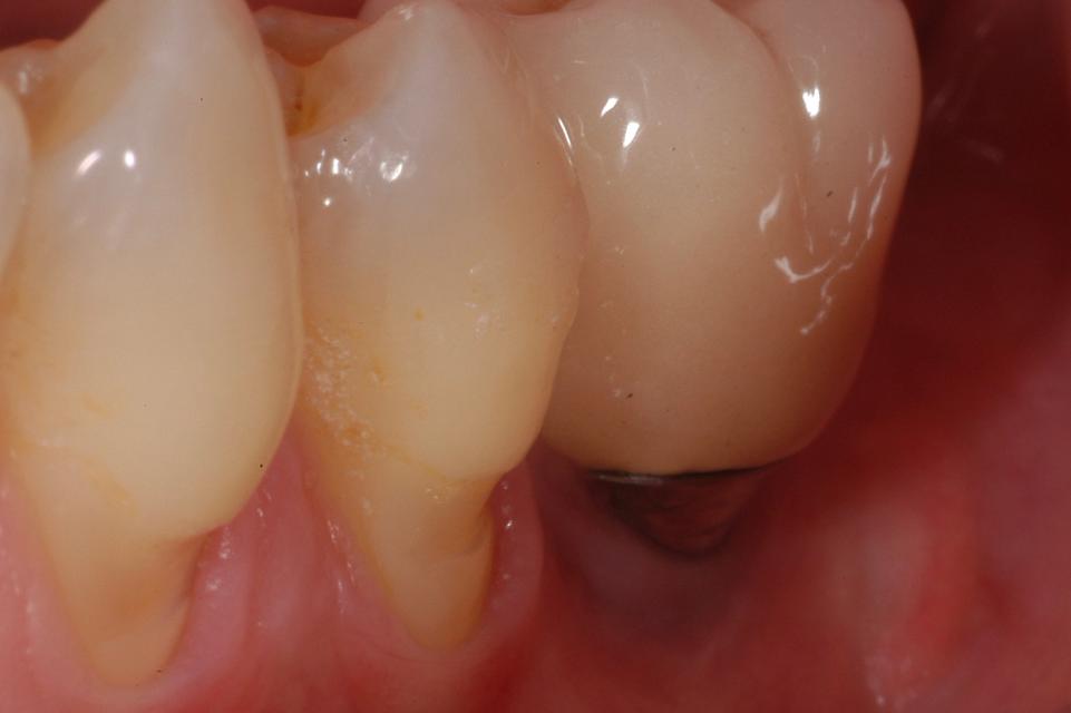 Fig. 4f: Clinical situation 4 years after delivery of the definitive crown. During a maintenance appointment, peri-implant soft tissue recession associated to brushing discomfort was noticed