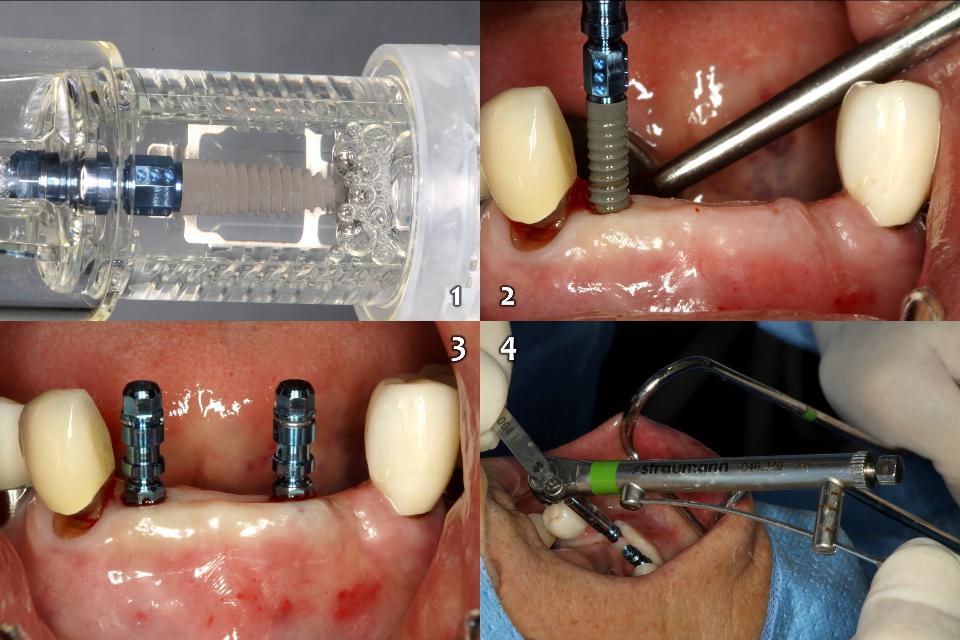 Fig. 10e: 2 implants (BLT, 2.9x12, NC, Roxolid, SLActive, Straumann) were placed on the lower anterior edentulous ridge (1 - 3) with 35 Ncm insertion torque (4)