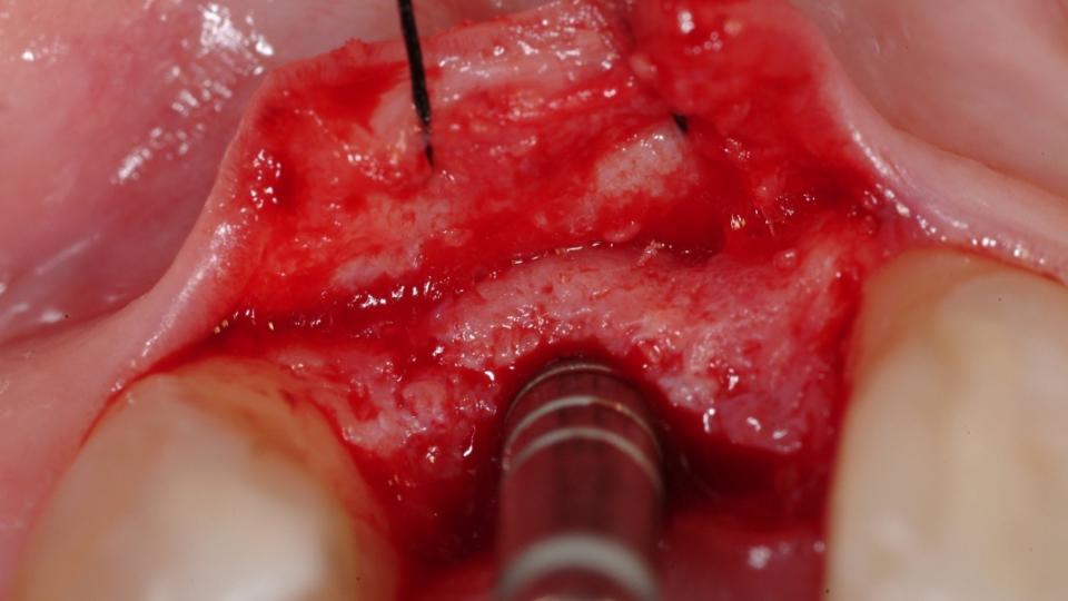 Fig. 10c: Preservazione della cresta + posizionamento implantare di tipo 4: Preparazione ottimale del letto implantare, che permette di ottenere un osso vestibolare spesso.