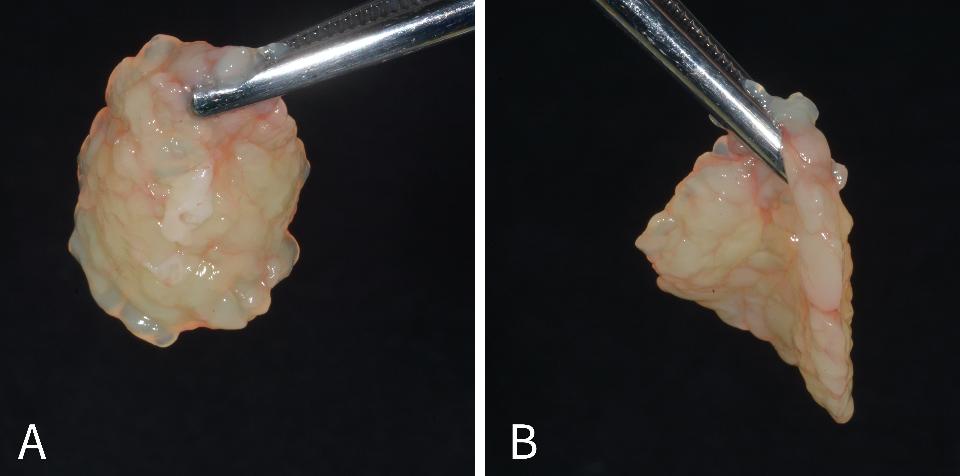 Fig. 12: Foto clínica de uma membrana de e-FRP utilizada para recobrimento de recessão. (Caso realizado pelo Dr. Nathan Estrin).