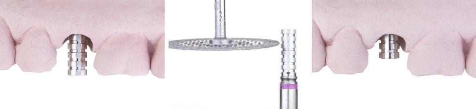Fig. 3i: Adjustment of the height of the titanium provisional abutment with a diamond disk
