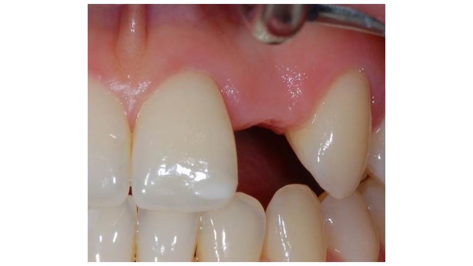 Fig. 6: Clinical picture of a missing maxillary lateral incisor with narrow interdental width