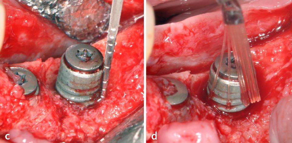 Şekil 4c – d: d: Flep açıldıktan sonra, sınıf II peri-implant kemik defekti (suprakrestal/horizontal defekt) tanımlanmıştır (Monje ve diğerleri 2019). Granülomatöz dokunun uzaklaştırılması ve implant yüzeyinin dekontaminasyonu için farklı uçlarla Er:YAG lazer kullanılmıştır (d) (AdvErL EVO, J. Morita, 2940nm, 25 pps, 50 mJ, su/hava oranı 7/10)