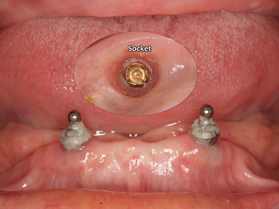 Fig. 16a: Over the past 30 years, I carried out many implant surgeries for my patients and provided many kinds of retentive devices to implant overdenture cases including ball & socket, bar & clip, and Locator etc. Like in this picture, most of the mechanical-/frictional-retentive devices have severe hygiene problem due to the space between 2 components (outer cap and inner core). And also, most of the retentive parts have broken down and lost their retentive effect in a short period