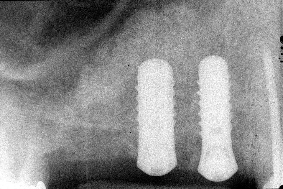 Fig. 6g: The post-surgical radiograph shows the two inserted implants in position 14 and 15. Note the deep insertion technique of the TL implants providing additional primary implant stability due to the tulip implant shape in the crestal area