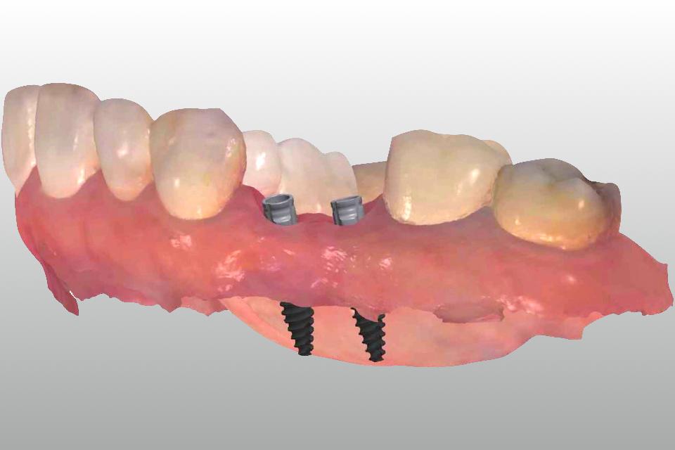 Fig. 42: Virtual titanium base abutments were placed onto the implants