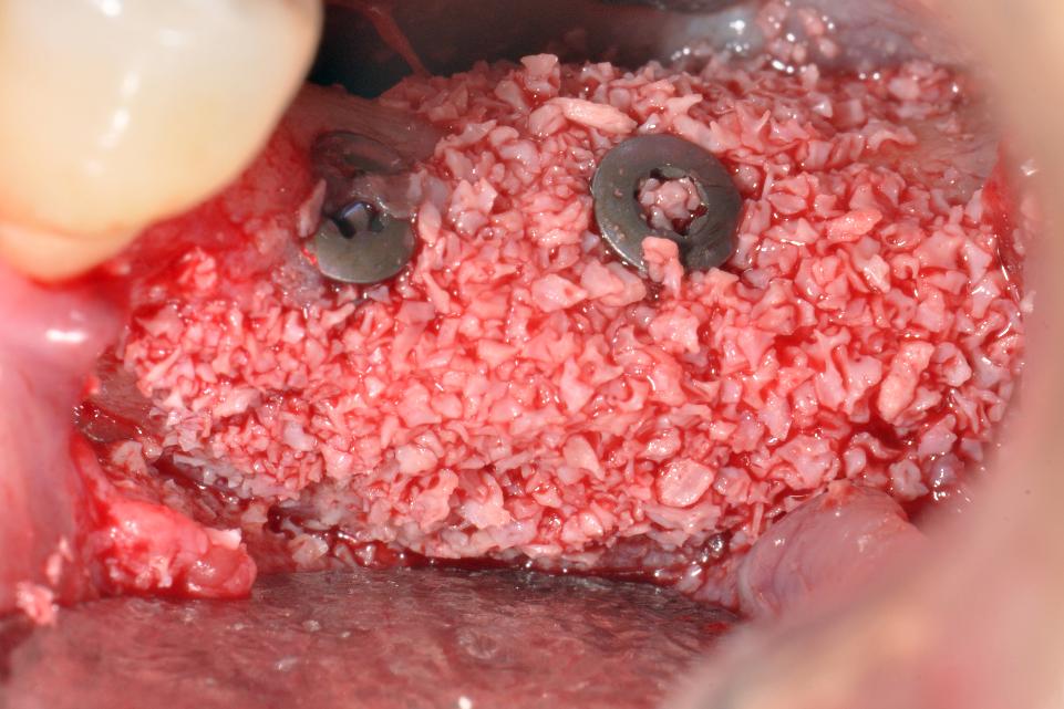 Fig. 4e: Guided bone regeneration (GBR) was carried out using xenograft and a collagen membrane