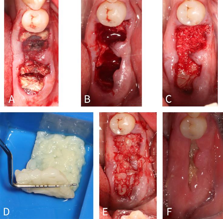 Fig. 13: Caso clínico usando a membrana de FRP estendida como um substituto para membrana de barreira de colágeno após o tratamento do local da extração. (A) Seccionamento dos dentes. (B) Após a extração do dente. (C) Enxerto com osso alógeno com fragmentos de FRP. (D) Fabricação da membrana de e-FRP após tratamento térmico a 75 C por 10 minutos no dispositivo Bio-Heat. (E) Membrana  de FRP estendida no lugar com sutura. (F) Uma semana após a operação. Observe a excelente cicatrização. (Caso realizado pelo Dr. Nathan Estrin).