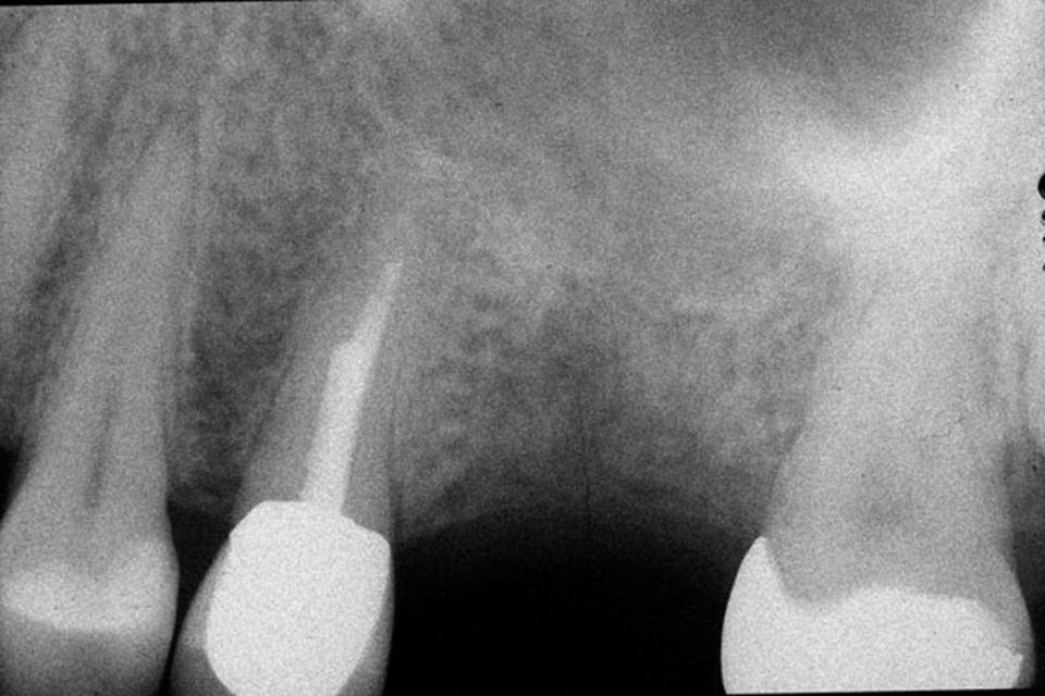 Fig. 8b: The 6 months periapical radiograph showed a flat anatomy of the maxillary sinus and a bone height of 5 - 6 mm