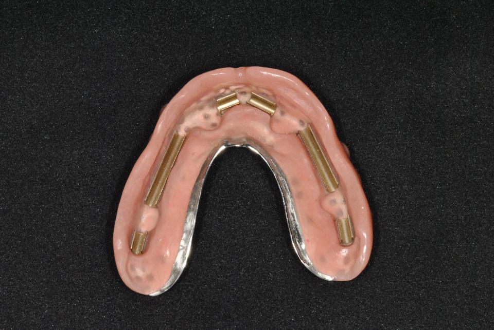 Fig 2b: Depending on the indication, a removable implant-supported, bar-retained prosthesis is recommended for edentulous patients. It can be cleaned more easily than fixed full arch prostheses, but is still extremely stable. Labwork mundwerk dental (Bern)