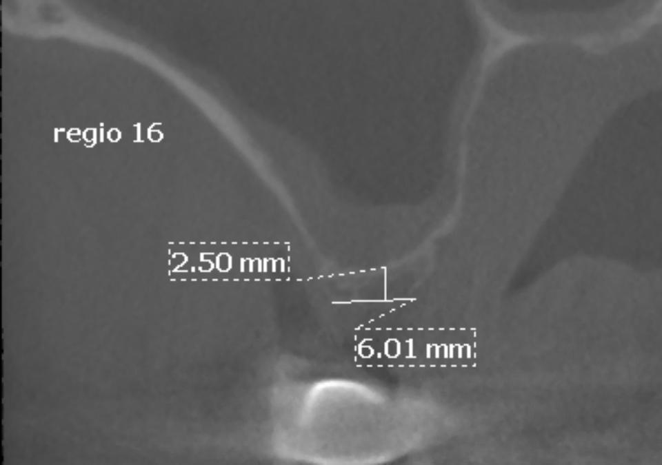 Fig. 2f: The oro-facial CBCT in area #16 shows sufficient crest width, but a ridge height of only 2.5 mm, requiring a staged SFE procedure