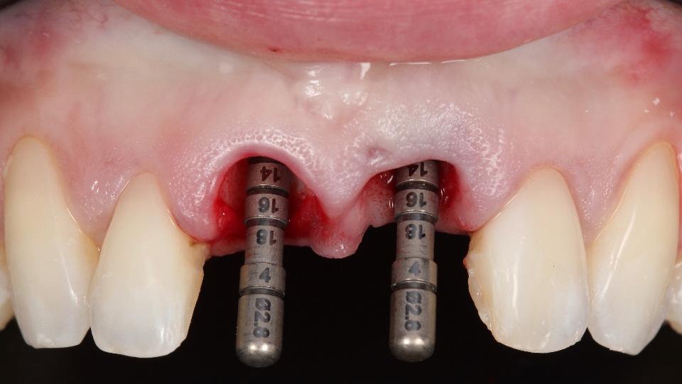 Abb. 5f: Statische computergestützte implantologische Operation mit vollständig geführtem Protokoll für die Sofortimplantation – Einsatz der Tiefenmesslehre (ø 2,8 mm) zur Bestätigung der Position des Implantatlagers