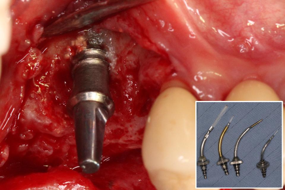 Fig. 3c: Após o levantamento do retalho, foi identificado um defeito ósseo peri-implantar classe Ib (defeito infraósseo de 2-3 paredes) (Monje et al., 2019). O laser de Er:YAG com diferentes pontas foi empregado para remoção de tecido de granulação e descontaminação da superfície do implante (AdvErL EVO, J. Morita, 2940 nm, 25 pps, 50 mJ, água/ar na proporção de 7/10).