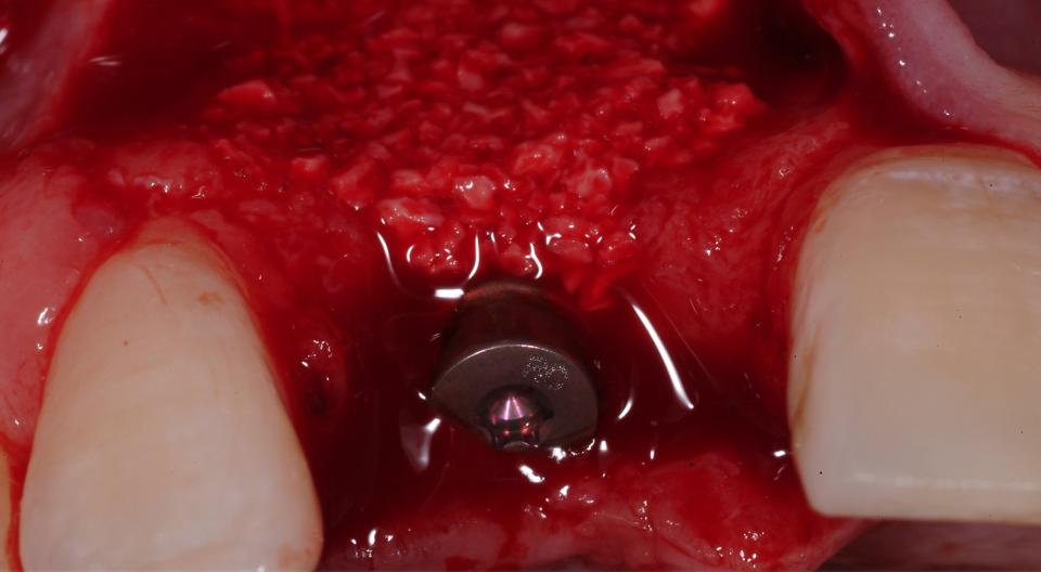 Fig. 9c: Pose d'un implant de type 2 : Préparation optimale du lit implantaire avec augmentation des contours.