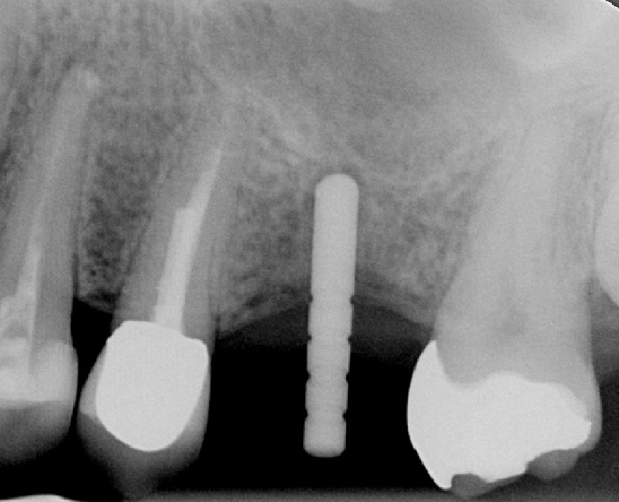 Fig. 8d: The periapical radiograph confirmed the correct depth of the preparation