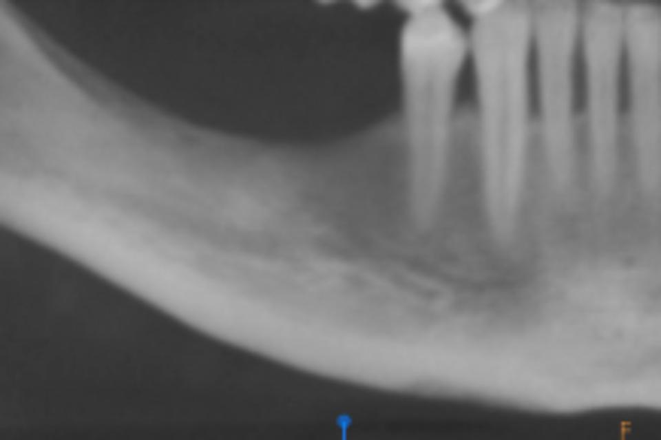 Fig. 1b: Preoperatory panoramic view, vertical deficiency on posterior mandible