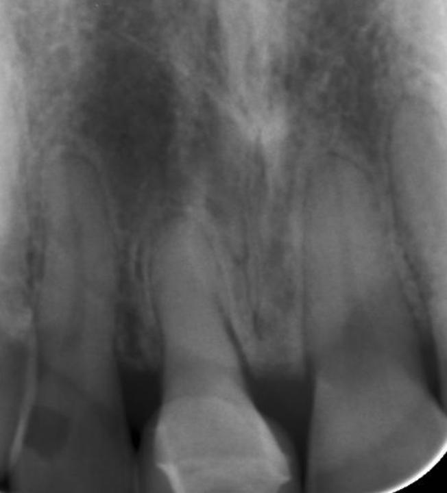Fig. 9b: Autotrasplante. Radiografía periapical 37 años después del autotrasplante de un segundo premolar mandibular en el área 11. El conducto radicular está obliterado. El espacio del ligamento periodontal está dentro del margen de lo normal y no hay signos de resorción radicular o inflamación periapical