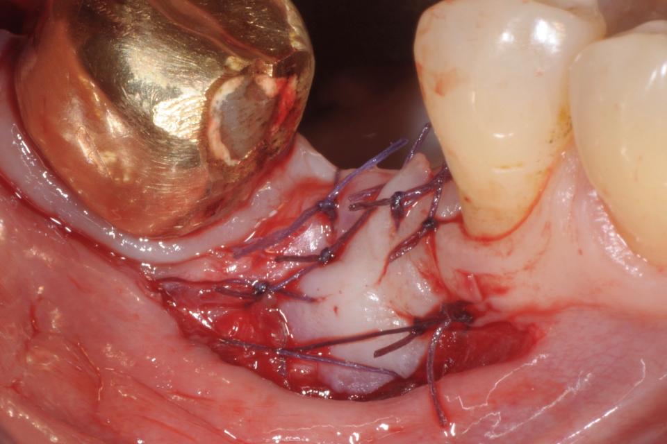Fig. 3c: A free gingival graft, harvested from the tuberosity, was sutured to the periosteum left in situ after the elevation of a split thickness flap