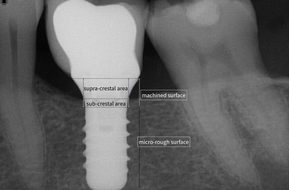 Fig. 11: Submerging 1 mm, a hybrid tissue level implant guarantees minor bone resorption confined to the smooth machined collar