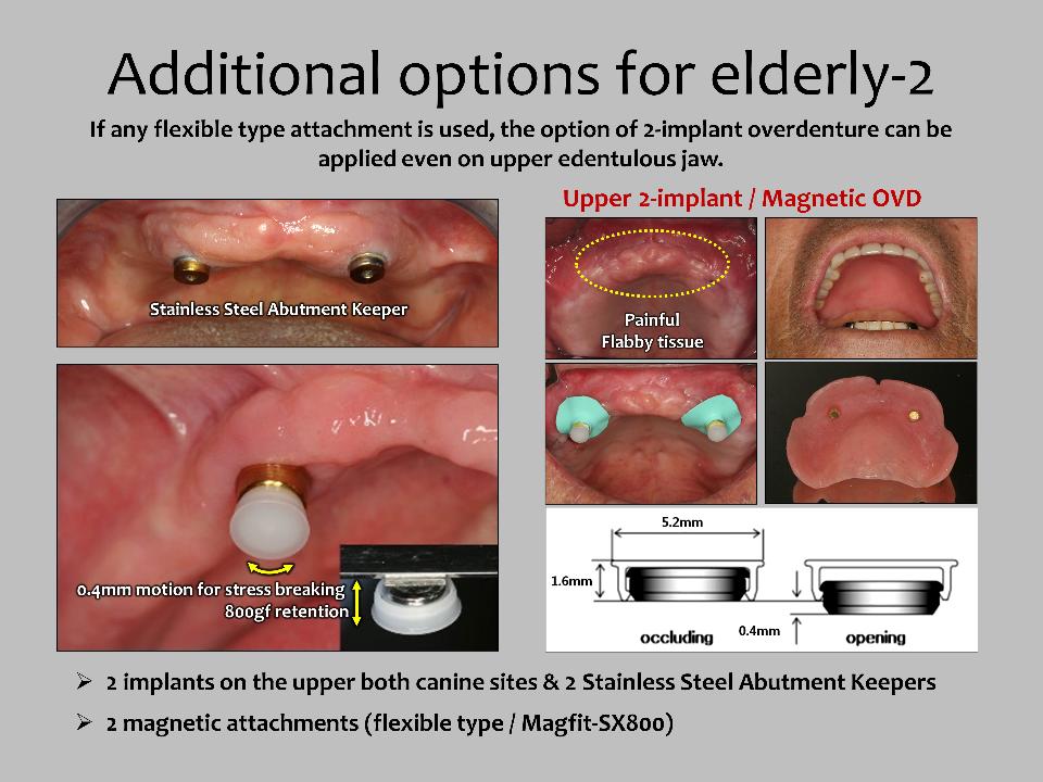 Fig. 9: As additional options, 2-implant-retained overdenture can be provided for the upper edentulous jaw with the flexible type of magnetic attachment (Magfit-SX800, Aiichi Steel, Japan) which can move 0.4 mm up and down while maintaining a magnetic force of 800 gf, and also slightly rotate and twist. This flexible/self-adjusting type magnetic attachment has 3 clinical characteristics. 1: 0.4mm vertical space between magnetic assembly & plastic (PMMA) cap; 2: 0.4mm vertical movement, 8° roll/pitch/yaw motion; self-adjusting the denture movement during function; and 3: flexible function, stress-breaking to the implant/abutment. It prevents flabby tissue occurring by stopping the progression of upper anterior alveolar bone resorption, eliminates pain induction on the mucosa, and improves the incisal biting ability of the upper denture