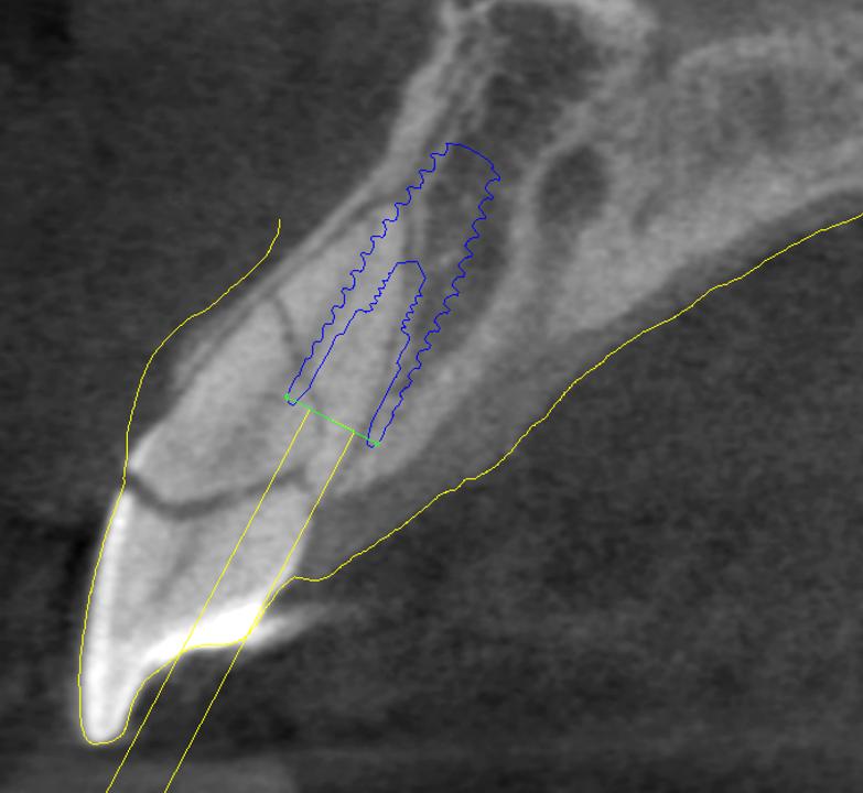 Fig. 5: Sélection optimale du cas et planification de l'implant pour le protocole de pose 1A.  -> Parois alvéolaires intactes. -> Os vestibulaire d'une épaisseur d'au moins 1 mm. -> Pas d'infection aiguë sur le site. -> Au moins 3 mm d'os apical et lingual par rapport à l'alvéole pour assurer la stabilité primaire. -> Phénotype des tissus mous épais.
