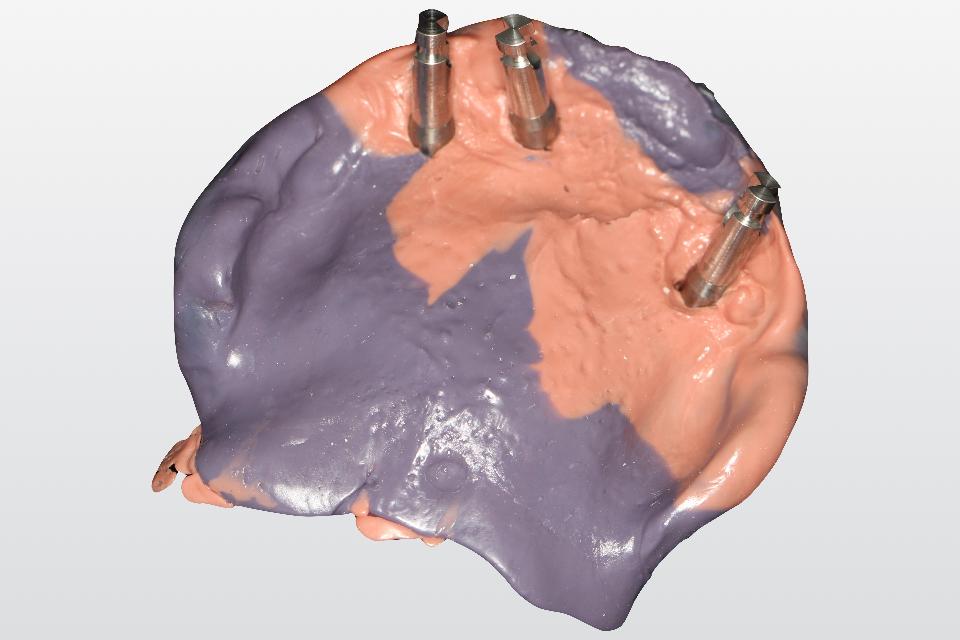 Fig. 10: When the registration of soft tissue’s dynamic/functional movement is indicated for an implant-retained prosthesis, a traditional analog impression can be made to obtain proper soft tissue extension