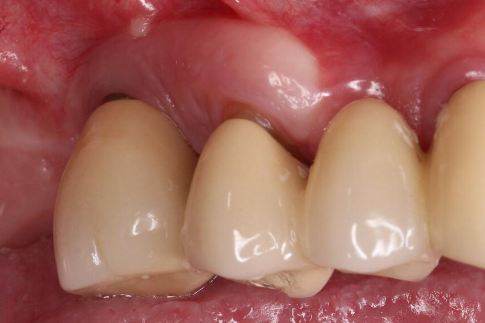 Fig. 3s: Acompanhamento de 6 anos após a cirurgia de ROG. Resultado estável foi mantido.