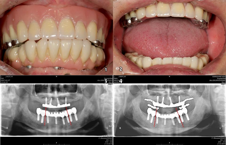 Fig. 8b: This treatment option on the lower jaw is so-called the ‘fixed segmented hybrid restoration method’ that places 4 - 6 implants on the severely absorbed and lower height of the jawbone with the help of artificial gums. Later, this option developed into today's ‘All-on-X’ method with the development of digital dentistry (1 - 2). By the way, to produce such a large, long-span fixed prosthesis precisely and esthetically high in its entirety, both excellent analog technology and digital workflow are required. In the periodic panoramic view (3 - 4), there was no crestal bone resorption on 5 implants (TL, Ti, SLA, Straumann) in maxilla and 8 implants (TL, Ti, SLA, Straumann) in mandible since 2007