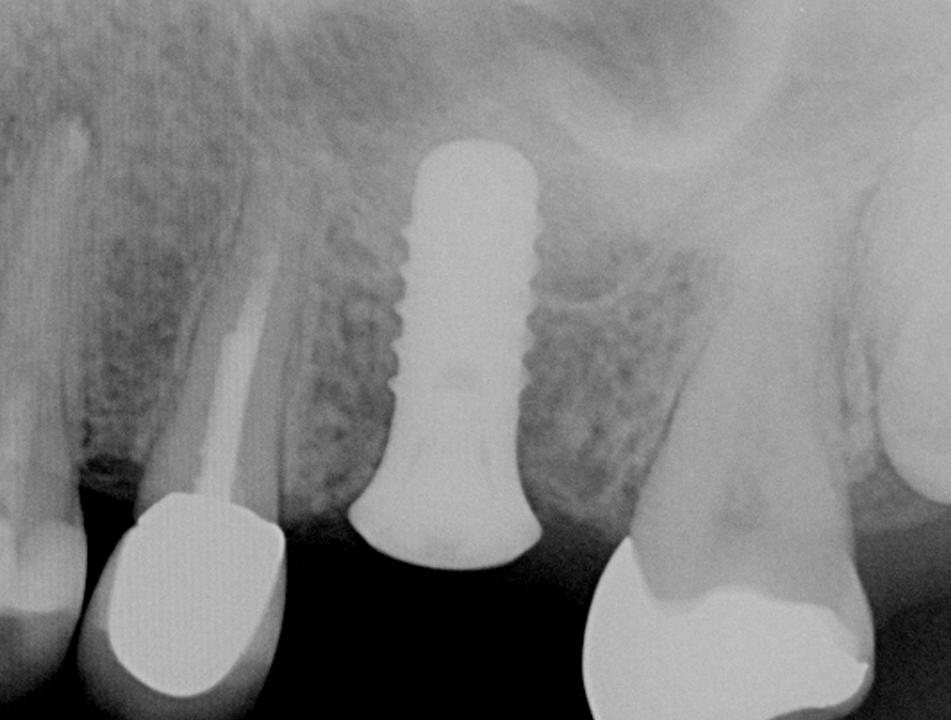 Fig. 8i: The post-surgical radiograph shows the inserted Wide Neck implants. The grafting material is clearly visible in the periapical area