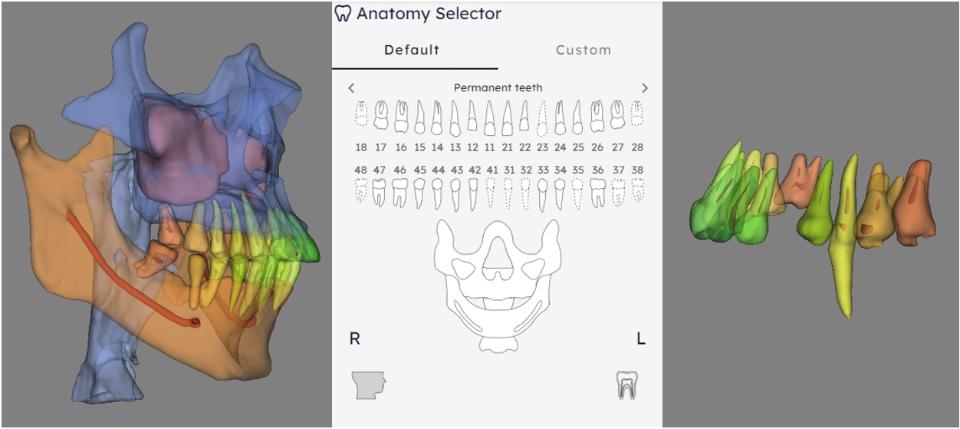 Fig. 8: Exemplos de rotulagem e segmentação dentária imprecisa em uma plataforma de IA. O terceiro molar inferior direito, inclinado e deslocado, foi erroneamente rotulado como segundo molar inferior direito. Os segundos pré-molares superiores e inferiores esquerdos foram identificados erroneamente como o segundo pré-molar superior, resultando no segundo pré-molar inferior sendo erroneamente rotulado como ausente. As câmaras pulpares e os canais radiculares de todos os dentes não estavam totalmente segmentados.