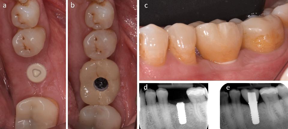 Fig. 4: (a) Clinical image of a two-piece zirconia implant with a healing cap after 6 months of healing. (b)  Occlusal view of the screw-retained single crown showing the size of the access cavity. (c) Lateral view of the tissue-level implant at the time of crown insertion. (d) Radiographic image at the time of implant placement. (e) Radiographic image after crown insertion