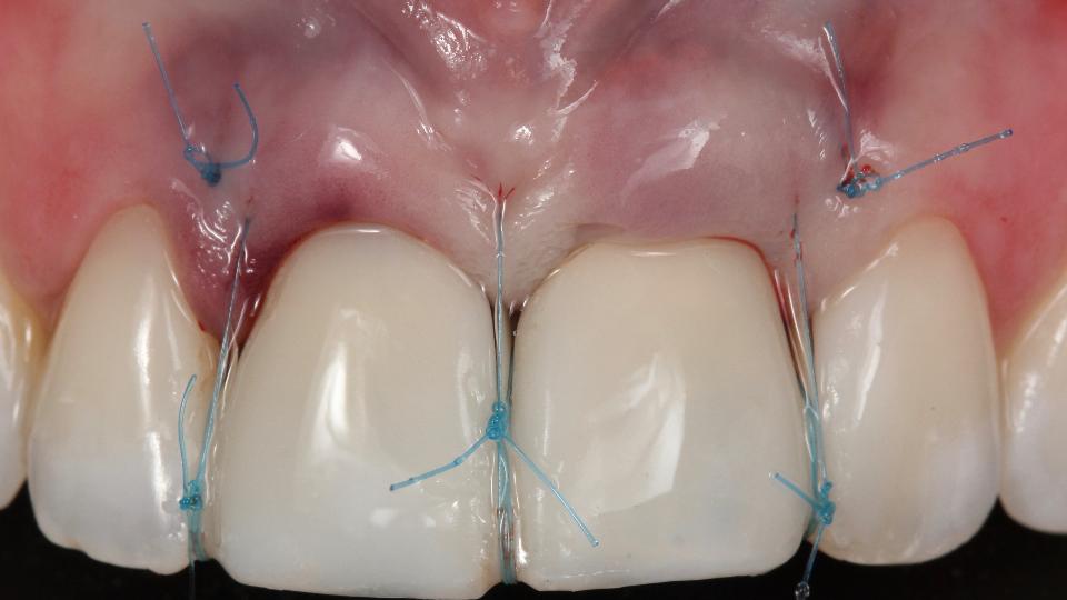 Fig. 7c: Protocollo di tipo 1a – vista frontale dopo l'inserimento della corona provvisoria immediata