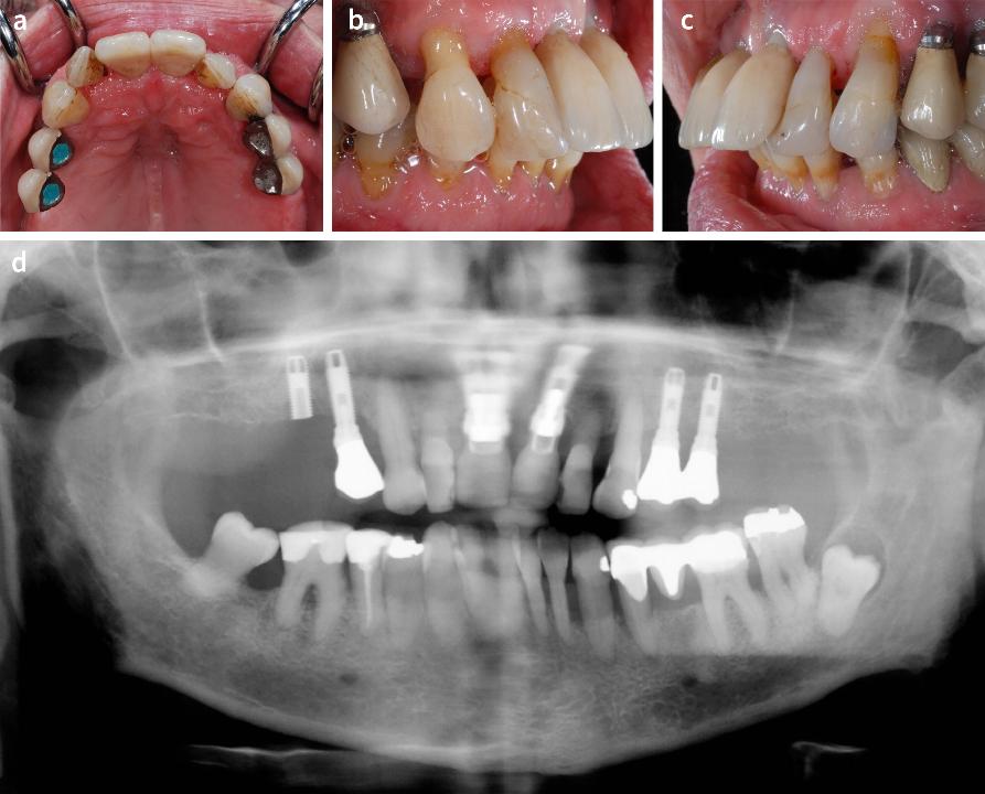 Fig. 11: Paciente de 52 años que perdió todos los molares superiores y recibió 4 implantes. Después de 3 episodios de aflojamiento de tornillos en el primer año de actividad, el paciente es derivado al prostodoncista para la evaluación de la prótesis. Todo el soporte posterior de la oclusión lo proporcionan los 4 implantes (a). Obsérvese la mordida profunda del paciente y la migración vestibular de los dientes anteriores (b, c). La tabla oclusal de los cuatro implantes superiores es inclinada, más parecida a un canino que a un premolar. Como resultado, durante la función, las fuerzas oclusales se transfieren lateralmente, dando como resultado un movimiento de flexión gradualmente creciente de la prótesis en dirección vestibular. Dicho movimiento puede ser perjudicial en particular para los tornillos de los pilares. En el examen clínico se encontró que el implante 15 se había fracturado después de menos de un año de funcionamiento (d)