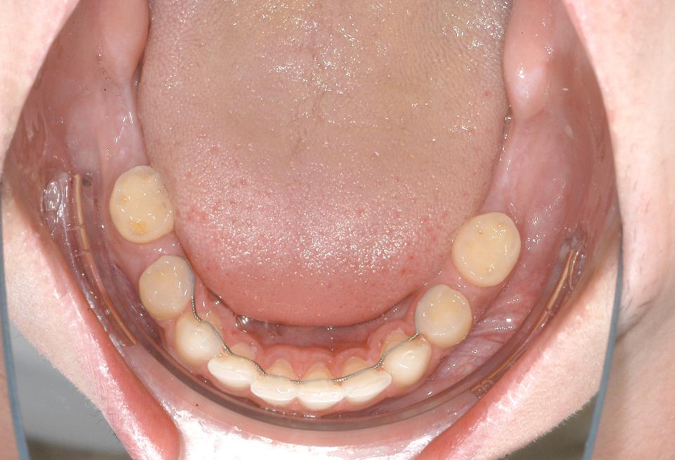Fig. 2c: Situação clínica inicial de um paciente do sexo masculino de 19 anos com displasia ectodérmica e ausência múltipla de dentes: visão oclusal inferior.