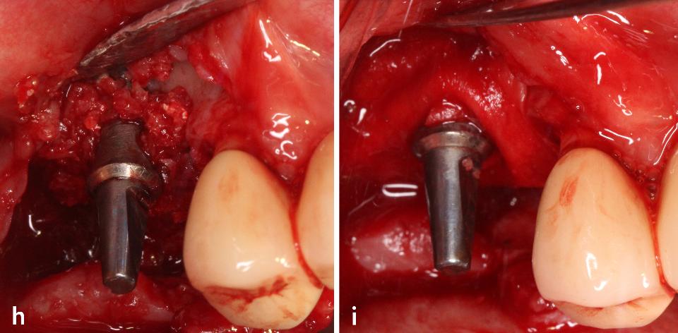 Fig. 3h – i: Guided bone regeneration (GBR) was carried out using autograft and a collagen membrane