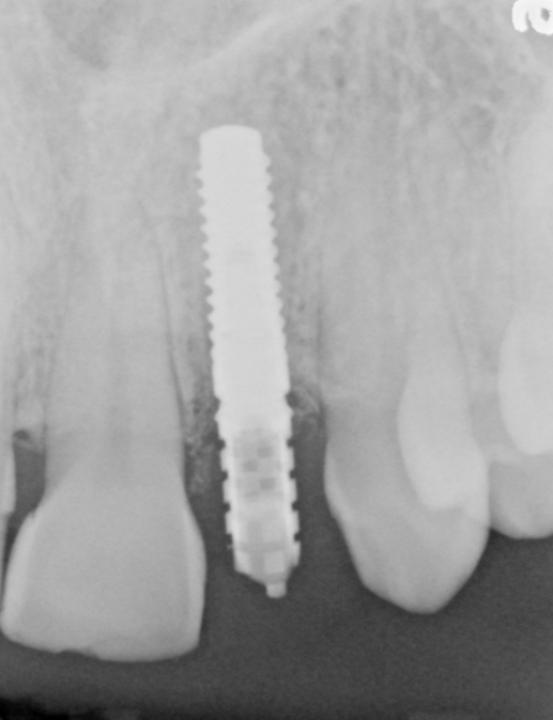 Fig. 2m: Control radiograph of the implant 3 months after placement