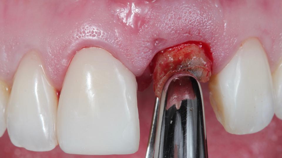 Fig. 2d: Tecnica minimamente invasiva per l'estrazione di un dente senza lembo – uso di pinze delicate per l'estrazione della radice