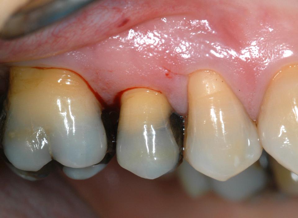 Fig. 4a: This case illustrates the type 1B protocol (immediate implant placement type 1 and early loading) to replace a maxillary second premolar:
This 47-year-old patient presented with a subgingival fracture of the palatal cusp of the upper right second premolar. Clinical examination revealed healthy periodontal tissues and normal probing pockets of 2 – 3 mm. The tissue phenotype was thick and bone walls were determined to be intact. The patient was not concerned about receiving a provisional tooth replacment. The conditions were appropriate for immediate implant placement and an early loading protocol (type 1B). This image was taken just after administration of local anesthesia