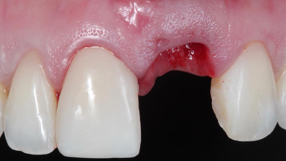 Fig. 2e: Tecnica minimamente invasiva per l'estrazione di un dente senza lembo – vista frontale dopo l'estrazione. Si noti la conservazione dell'architettura dei tessuti molli