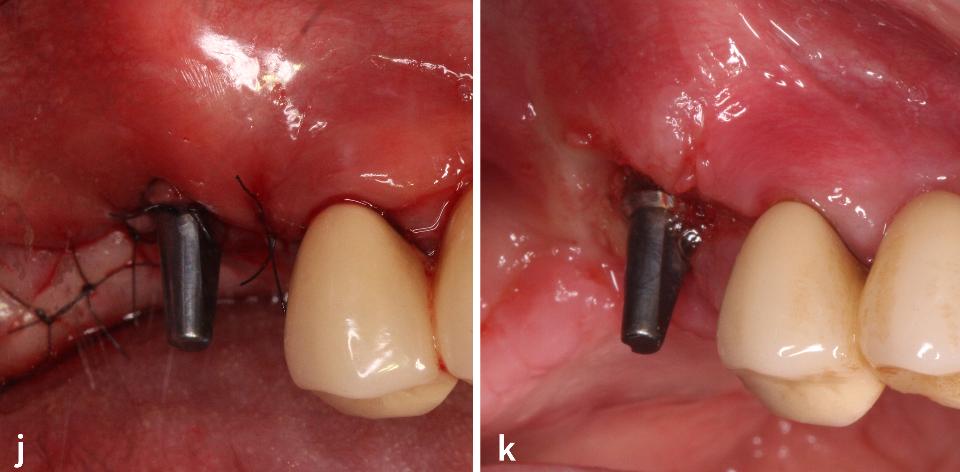 Fig. 3j – k: The surgical site achieved primary wound closure without submerging the implant (j). Subsequent follow-up at 2 weeks post-surgery (k)