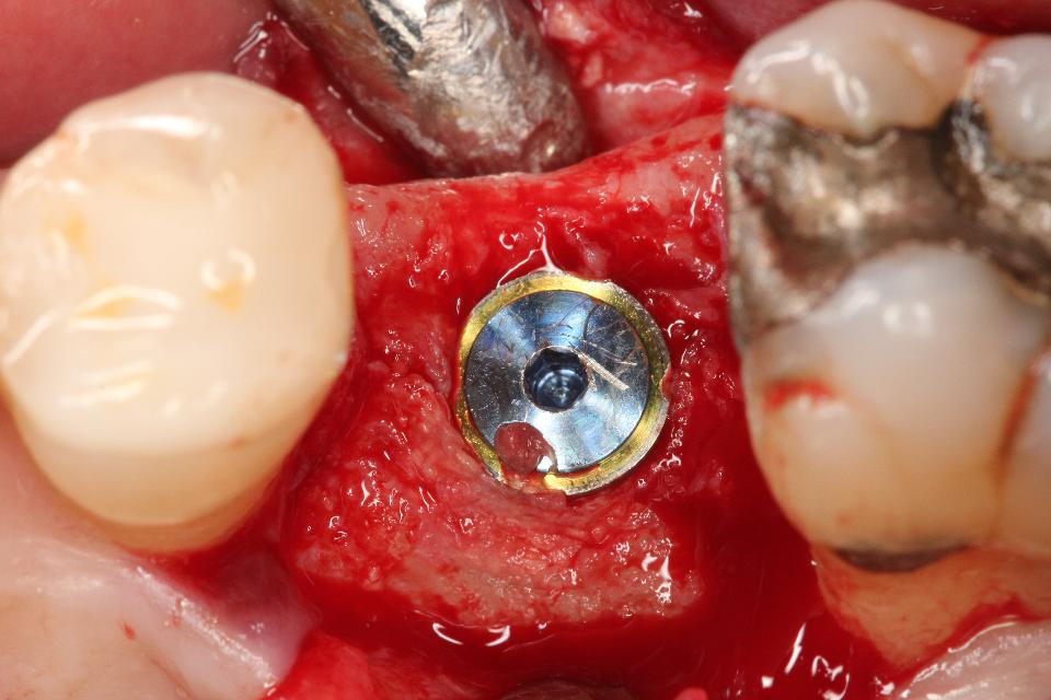 Fig. 41:  …and late implant placement could be performed