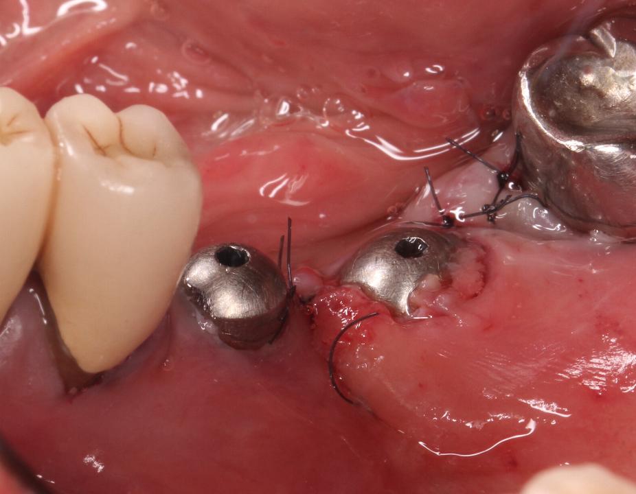 Fig. 2h: Le site chirurgical a subi une fermeture primaire de la plaie sans que l'implant ne soit immergé.