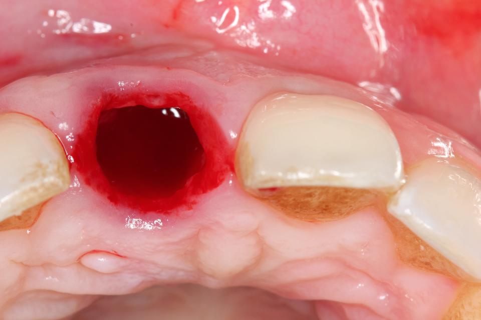 Fig. 25: Horizontal view following tooth extraction without flap elevation