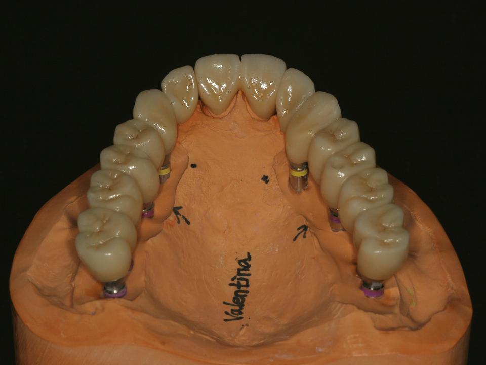 图. 6g: 通过第二步CAD/CAM工作流程制作的上颌氧化锆修复体 (Prettau, Zirkonzahn, Gais)。上颌双侧尖牙、第1前磨牙、第1、2磨牙采用螺丝固位氧化锆修复体，中切牙采用氧化锆全冠修复