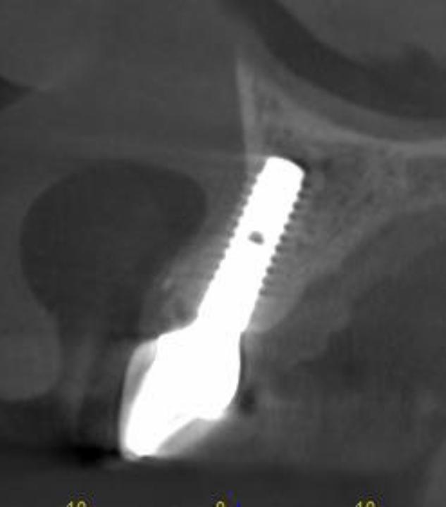 Fig. 2q: CBCT cross-section 2 years after type 1A placement protocol showing thick facial and palatal bone walls. The facial and palatal bone crests are at the shoulder of the implant