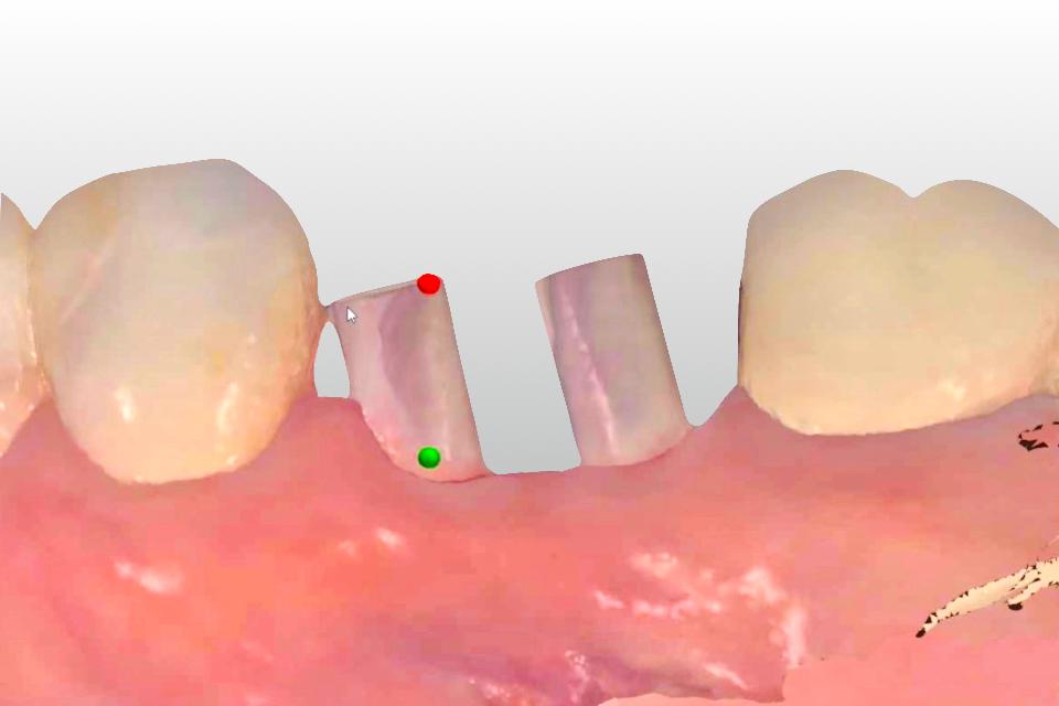 Fig. 41: A complete digital restorative workflow starts with an intraoral scan capturing implants’ position and timing with scan bodies