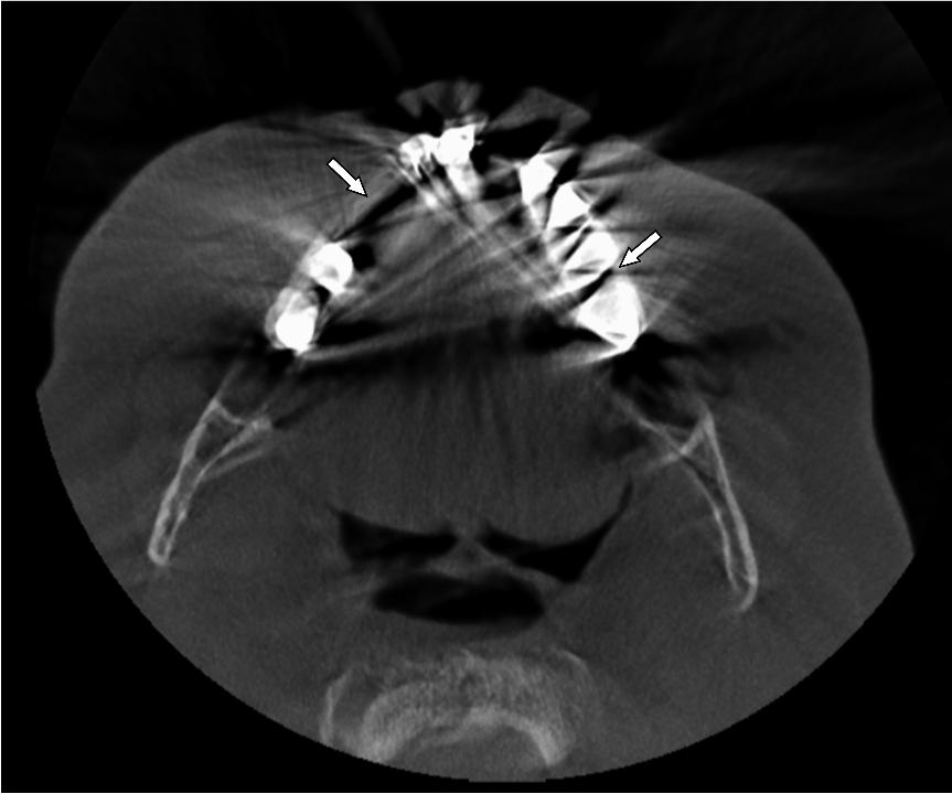 Fig. 5: Cone-beam computed tomography axial reconstruction of a patient presenting multiple metallic restorative materials. White arrows indicate zones between adjacent metallic materials where photon starvation artifacts are observed