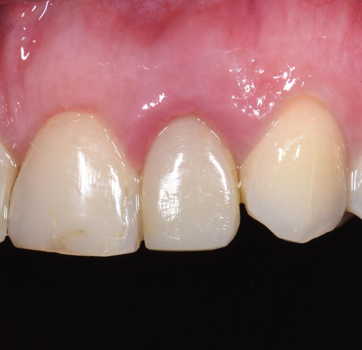 Fig. 2a: The following case illustrates the type 1A protocol (immediate type 1 implant placement and immediate provisional prosthesis) to replace a maxillary left lateral incisor:
A 44-year-old patient presented with a horizontal fracture of the maxillary left lateral incisor. The tissue phenotype was thick
