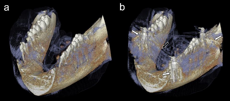 Fig. 12: Rendu volumétrique 3D en tomographie à faisceau conique d’une mandibule de porc sans (a) et avec (b) trois implants dentaires. On notera les artefacts liés aux implants, qui affectent la segmentation des tissus durs (flèches blanches) aussi bien que mous (flèche noire).